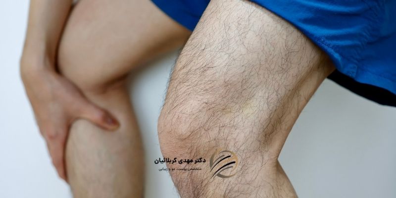 آیا حذف موهای بدن باعث ضخیم شدن موها می‌شود