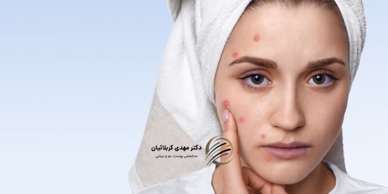 جوش زیرپوستی چیست