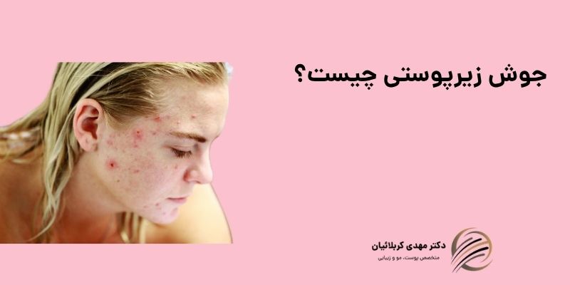 جوش زیرپوستی چیست