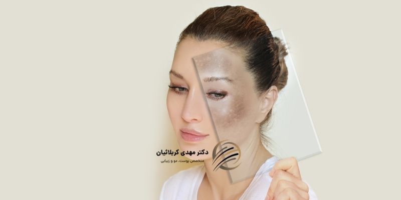 علائم افزایش ملانین پوست
