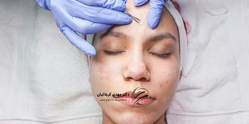 علت جوش زیر پوستی چیست