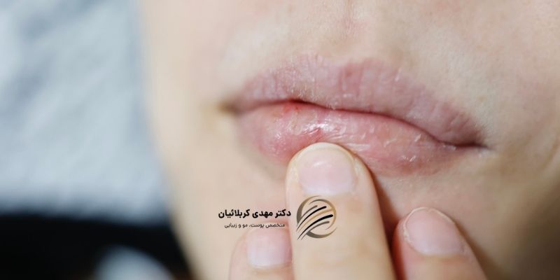 علت خشکی لب چیست؟