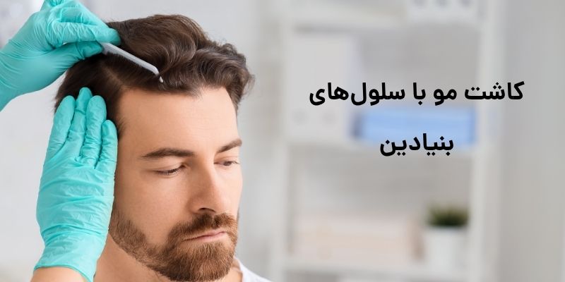 کاشت مو با سلول‌های بنیادی