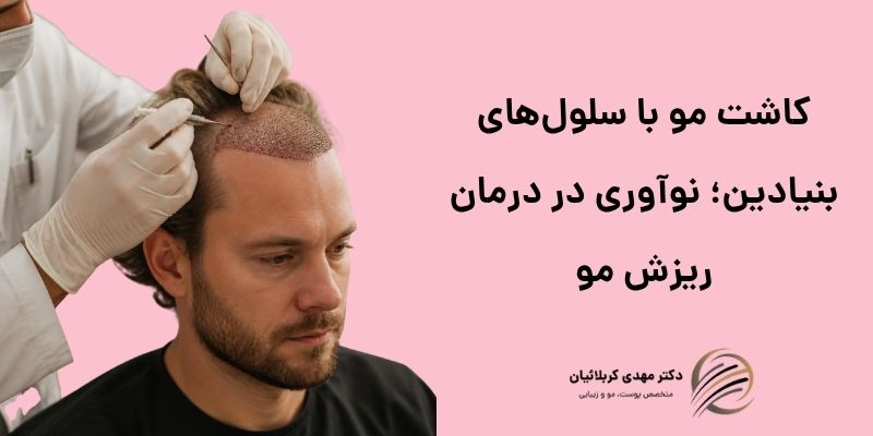 کاشت مو با سلول‌های بنیادی